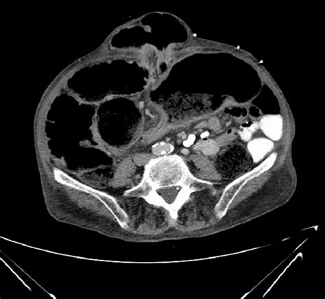 Abdominal Hernia Ct Scan