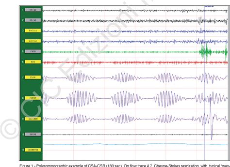 Figure 1 from Treatment of Cheyne-Stokes Respiration and Central Sleep Apnoea in Chronic Heart ...