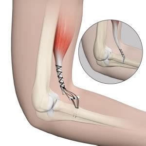 Distal Biceps Tendon Repair | Distal Biceps Tendon Tear