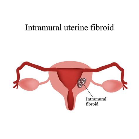 What Are The Symptoms Of Intramural Fibroids?