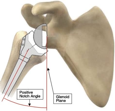 Infraglenoid Tubercle Of Scapula