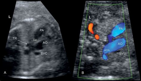 images | Subclavian artery, Ultrasound, Ultrasound sonography