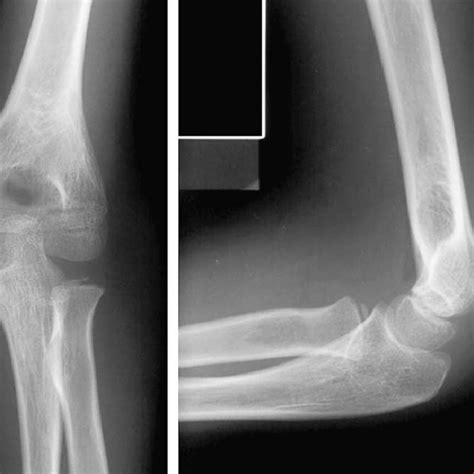 Case 9 e pelvis: OA right hip confused with subcapital fracture. | Download Scientific Diagram