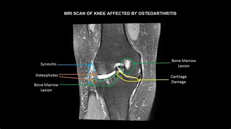 Osteoarthritis Knee Mri