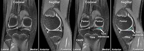 Meniscal Tear Knee Mri