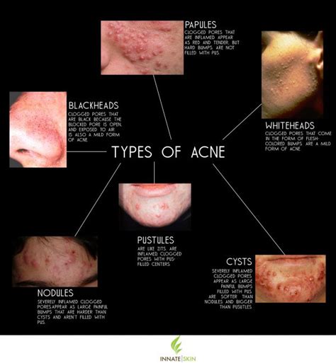 How to Recognize What Kind of Acne You Have | Innate Skin