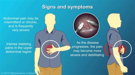 Chronic Pancreatitis - YouTube