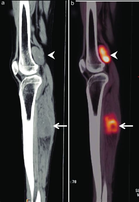 15 year old girl with synovial sarcoma of the calf referred for... | Download Scientific Diagram