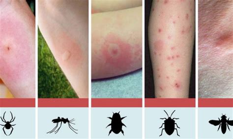 Discover How To Identify The 8 Most Common Insect Bites | Healthy Food Vision