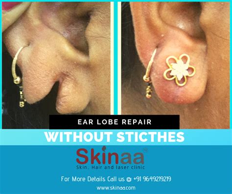 Ear Lobe Repair | Skin specialist, Ear, Repair