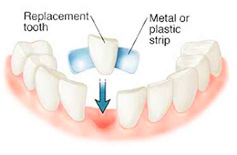 Dental Bridge - Procedure, Dental Bridge Vs Dental Implant