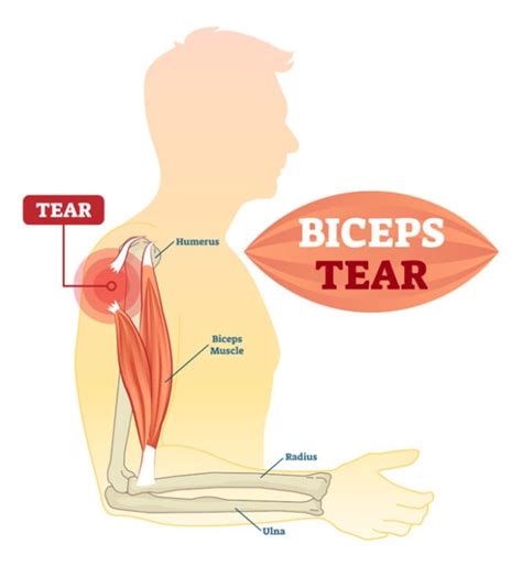 Bicep Tendon Tear Treatment | Las Vegas, Lake Havasu, Bullhead City Nevada