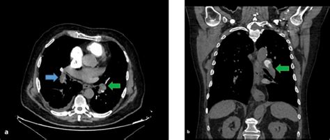 Computed tomography pulmonary angiography images of a 72-year-old male... | Download Scientific ...