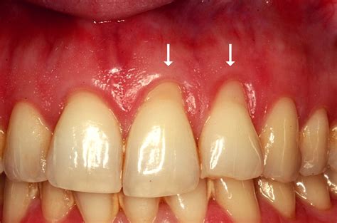 Receding Gums Stages