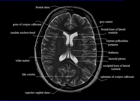 Mri Brain Anatomy