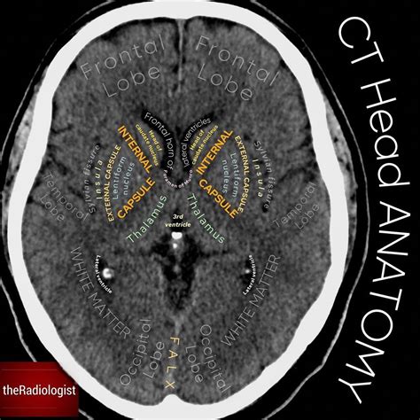 Basal Ganglia Anatomy Ct