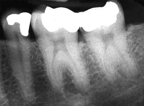 Taurodontism - Anomalies of Tooth Structure - Dentalcare