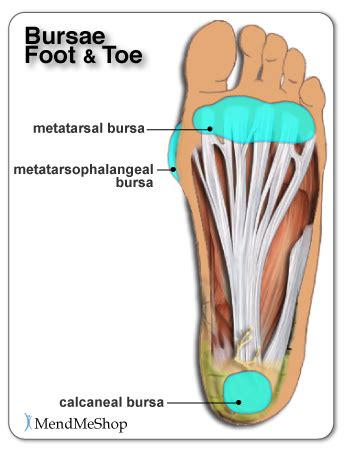 Bursitis in the Foot