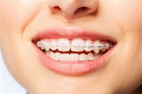 Best Invisible Braces in Chicago | Ceramic Braces in Chicago | American Dental