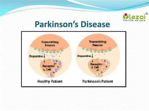 PPT - Parkinson’s Disease : overview, symptoms, causes, treatment and diagnosis PowerPoint ...