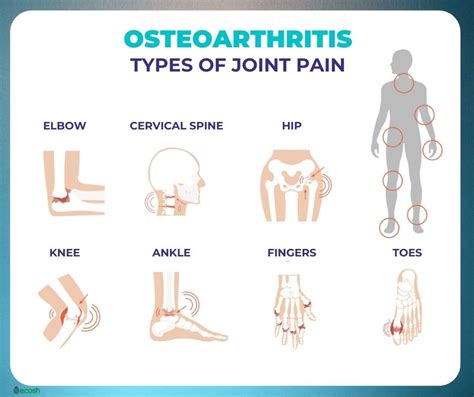 Osteoarthritis Prevention