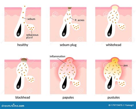 Acne Formation. Papule And Pimple Vector Illustration | CartoonDealer.com #213114996