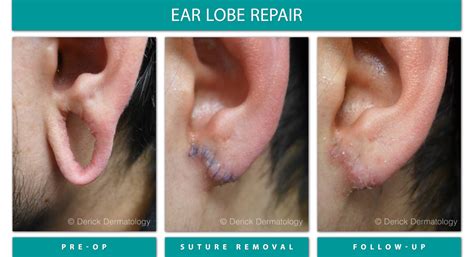 Before & After Gallery - Ear Lobe Repair - Derick Dermatology