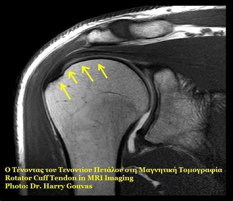 Rotator cuff surgery | General center | SteadyHealth.com