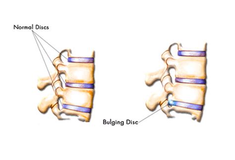 Bulging Disc | Bonati Spine Institute