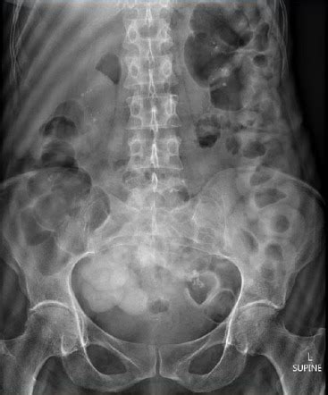 Medullary sponge kidney | Radiology Case | Radiopaedia.org