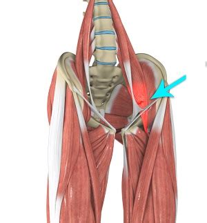 Hip Flexor Pain Causes