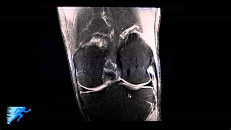 Knee Muscle Anatomy Mri - knee anatomy | MRI knee coronal anatomy | free cross ... - Each ...