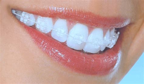 Invisible Braces Cost Philadelphia, Invisalign Dentist, Teeth Straightening Orthodontist