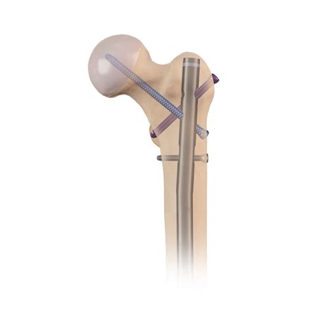 Arthrex - Femoral Nail System