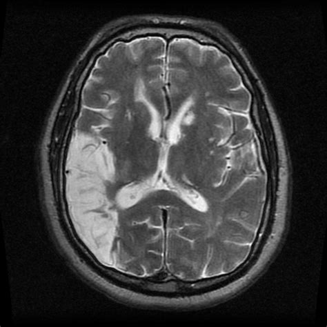 ENG case -- parietal lobe stroke