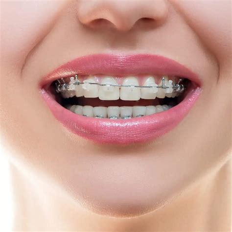 Best invisible braces - leomuscle