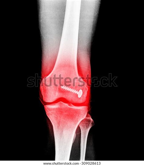 149 Femoral Nail Images, Stock Photos & Vectors | Shutterstock