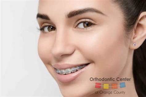 Taking Care of Your Braces | Invisalign in Santa Ana | OC Braces Care