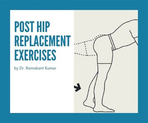 Posterior Hip Replacement Exercises