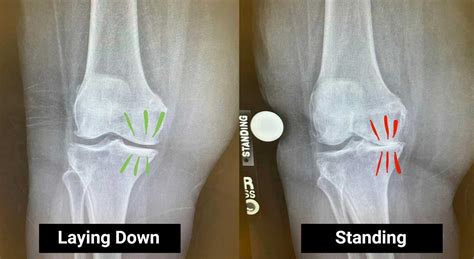 The importance of a standing knee X-ray to evaluate arthritis | Steve Meyers, MD