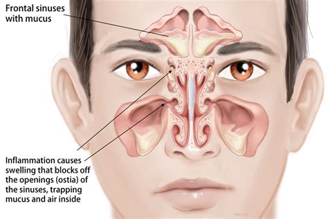 Pediatric ENT and Sinus Disease (Sinusitis)