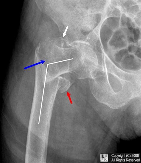 intertrochanteric hip fracture,intertrochanteric,hip fracture,hip,fracture,subcapital ...