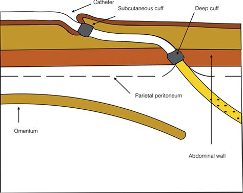 Peritoneal Dialysis Catheter Types