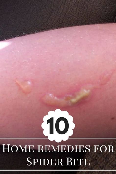 10 Natural Home Remedies for Spider Bite Treatment