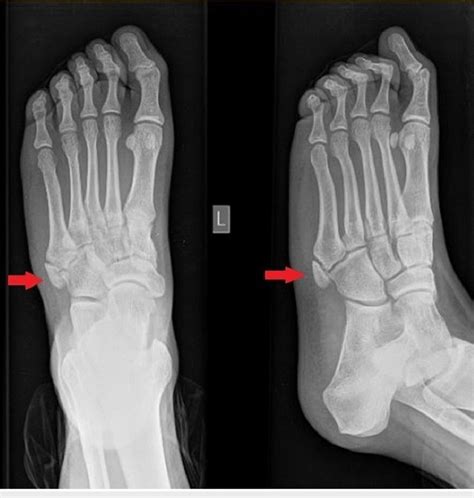 Plain radiograph (AP and lateral oblique) of the left foot (injured)... | Download Scientific ...