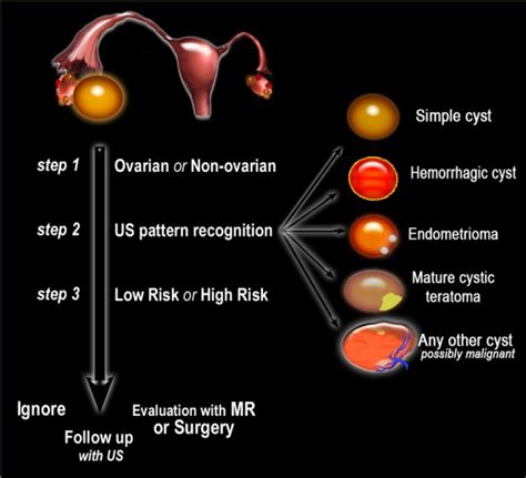 The Radiology Assistant : Roadmap to evaluate ovarian cysts