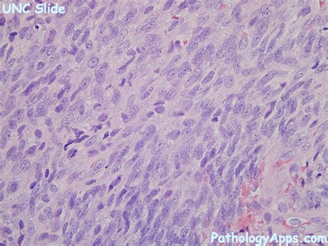 synovial sarcoma pathology