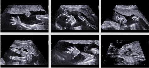 4D Ultrasound 20 Weeks - Images & Videos by A Date With Baby