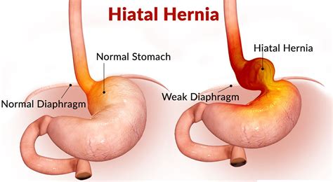 Hiatal Hernia - Causes, Symptoms, Diagnosis, Treatment and Surgery