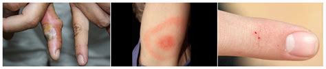 Black Widow Spider Bite: Symptoms and Treatments | New Health Advisor